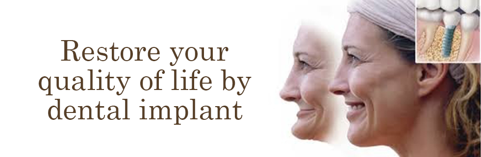 Dental Implants in Northridge, CA