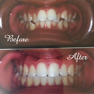 Before and after Braces in Northridge, CA