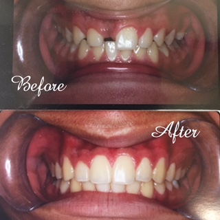 braces in Northridge, CA