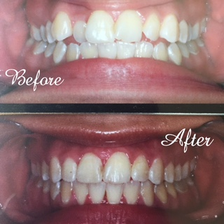 Orthodontist applies braces in Northridge, CA, and shows before and after.