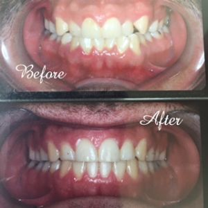 Showcasing what braces in Northridge, CA, can do!